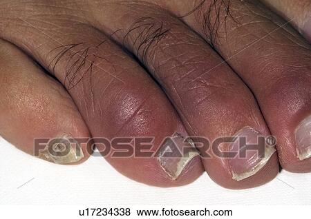Chilblains View Large Photo Image Stock Photo - Chilblains. Fotosearch