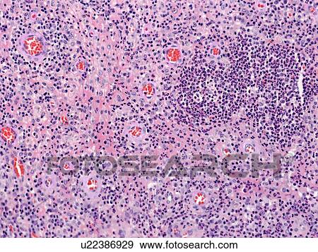 Chronic abscess, light micrograph View Large Photo Image Stock Photo - Chronic abscess, light micrograph. Fotosearch