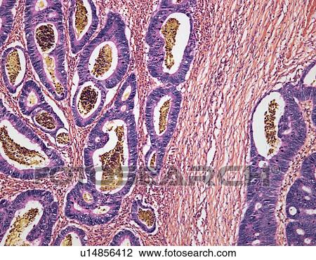 Colon cancer, light micrograph View Large Photo Image Stock Image - Colon cancer, light micrograph. Fotosearch