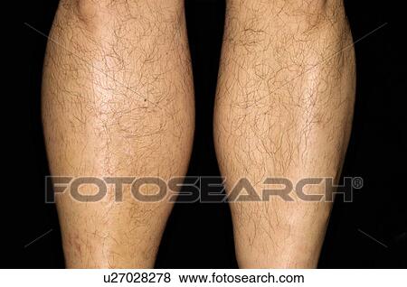 Deep vein thrombosis View Large Photo Image Stock Photo - Deep vein thrombosis. Fotosearch