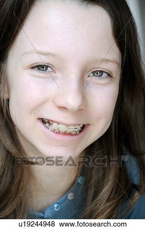Dental braces View Large Photo Image Stock Photo - Dental braces. Fotosearch