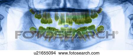 Picture - Dental X-ray. Fotosearch