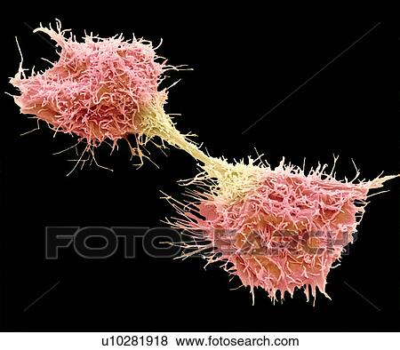 Dividing fibrosarcoma cells, SEM View Large Photo Image Stock Photo - Dividing fibrosarcoma cells, SEM. Fotosearch