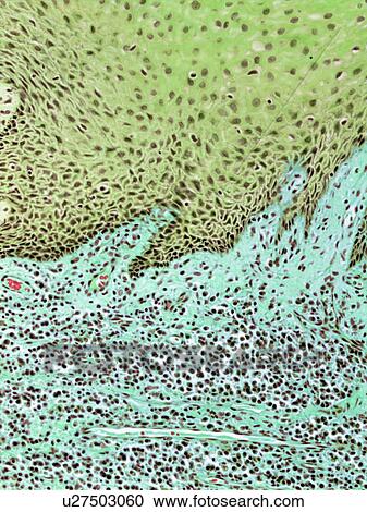Stock Image - Gingivitis, light micrograph. Fotosearch