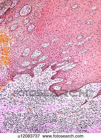 Gingivitis, light micrograph View Large Photo Image Stock Photo - Gingivitis, light micrograph. Fotosearch
