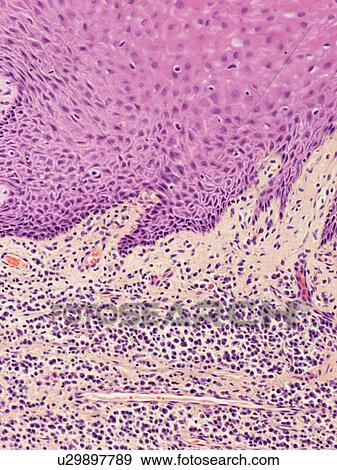 Stock Photo - Gingivitis, light micrograph. Fotosearch