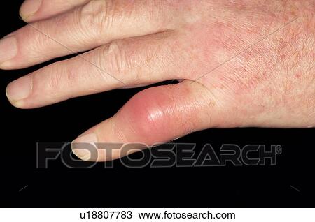 Gout View Large Photo Image Stock Image - Gout. Fotosearch