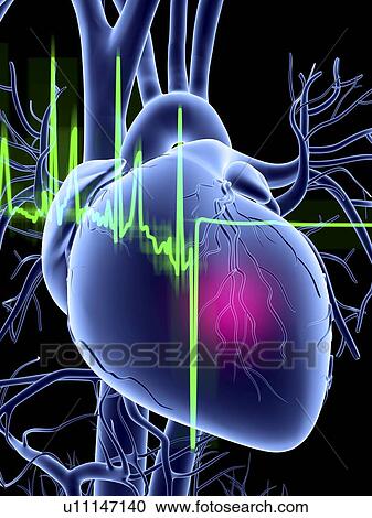 Stock Image - Heart attack and ecg trace. Fotosearch