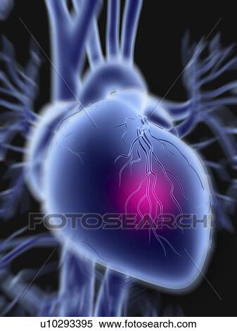 Heart attack View Large Photo Image Stock Photography - Heart attack. Fotosearch