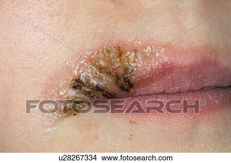 Impetigo View Large Photo Image Picture - Impetigo. Fotosearch
