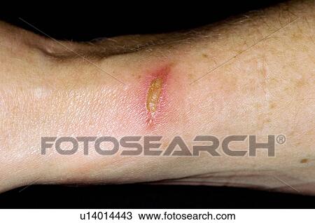 Stock Image - Infected burn. Fotosearch