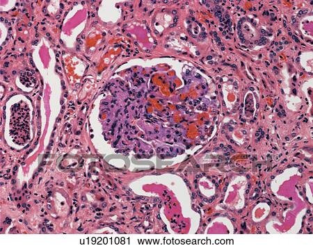 Inflamed kidney, light micrograph View Large Photo Image Stock Image - Inflamed kidney, light micrograph. Fotosearch