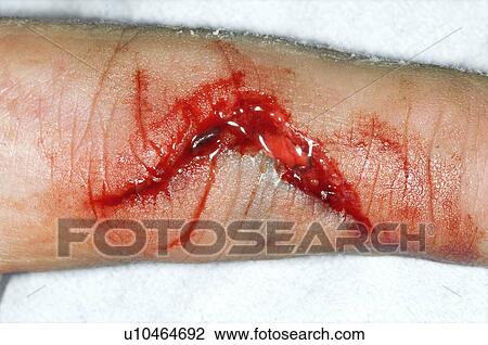 Stock Image - Lacerated finger. Fotosearch