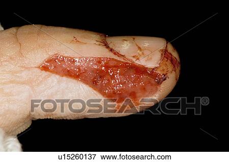 Stock Photo - Lacerated finger. Fotosearch