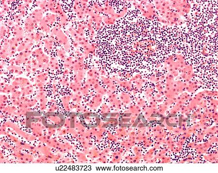 Stock Image - Leukaemia blood cells, light micrograph. Fotosearch
