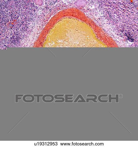Stock Image - Lung aneurysm, light micrograph. Fotosearch