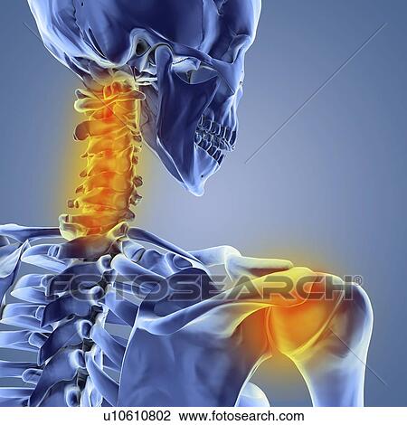 Neck and shoulder pain, computer artwork View Large Photo Image Stock Image - Neck and shoulder pain, computer artwork. Fotosearch