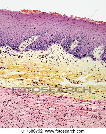 Stock Image - Neurofibroma, light micrograph. Fotosearch
