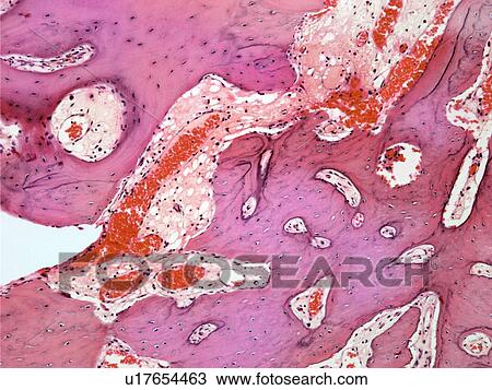 Stock Image - Osteoid osteoma, light micrograph. Fotosearch