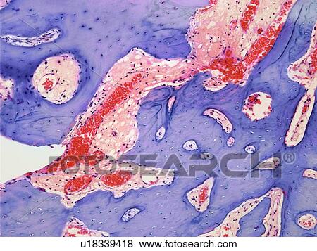 Stock Photo - Osteoid osteoma, light micrograph. Fotosearch