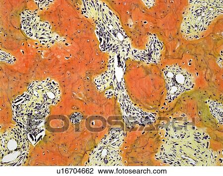 Stock Image - Paget's disease, light micrograph. Fotosearch