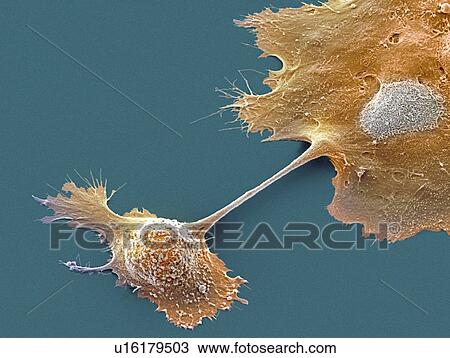 Stock Image - Pancreatic cancer cells, SEM. Fotosearch