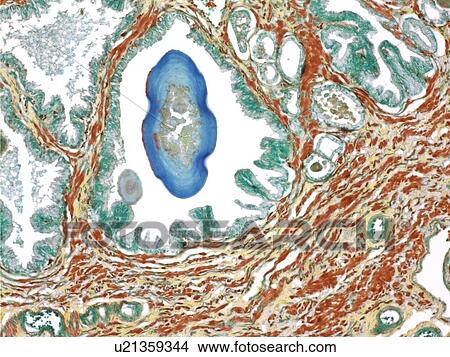 Picture - Prostate, light micrograph. Fotosearch