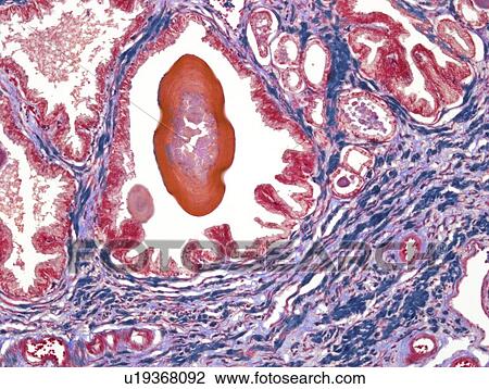 Stock Image - Prostate, light micrograph. Fotosearch