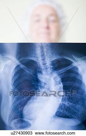 Scoliosis diagnosis View Large Photo Image Stock Image - Scoliosis diagnosis. Fotosearch