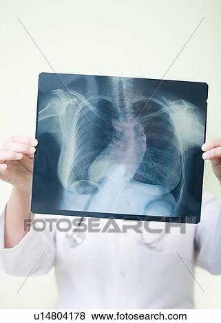 Scoliosis diagnosis View Large Photo Image Stock Photo - Scoliosis diagnosis. Fotosearch