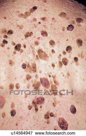 Stock Photo - Seborrhoeic warts. Fotosearch
