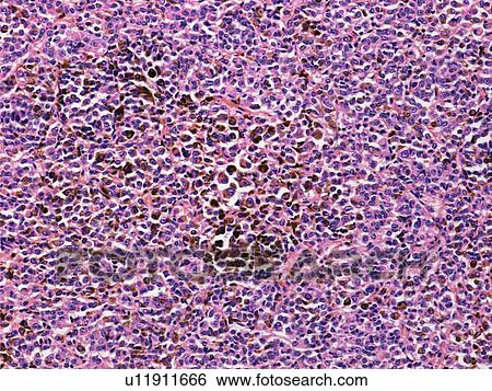 Secondary liver cancer, light micrograph View Large Photo Image Stock Photograph - Secondary liver cancer, light micrograph. Fotosearch