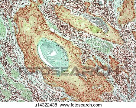 Skin cancer, light micrograph View Large Photo Image Stock Photo - Skin cancer, light micrograph. Fotosearch
