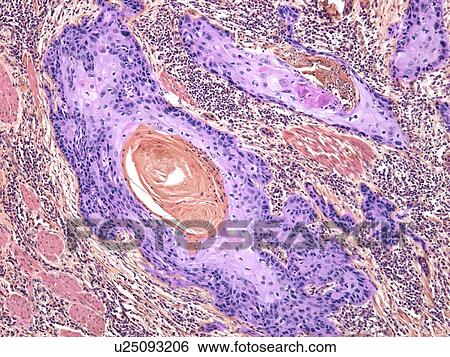 Stock Photograph - Skin cancer, light micrograph. Fotosearch