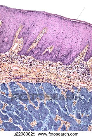 Skin cancer, light micrograph View Large Photo Image Stock Photography - Skin cancer, light micrograph. Fotosearch