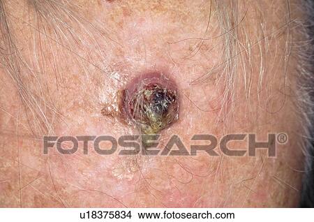 Skin cancer View Large Photo Image Picture - Skin cancer. Fotosearch