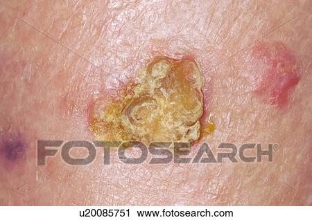 Stock Image - Skin cancer. Fotosearch