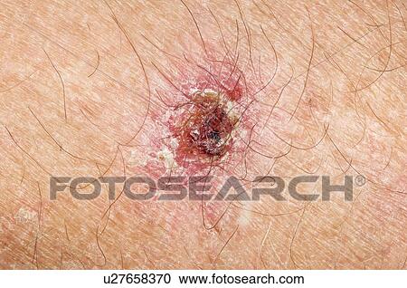 Skin cancer View Large Photo Image Stock Image - Skin cancer. Fotosearch