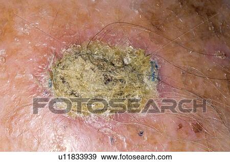 Stock Photo - Skin cancer. Fotosearch