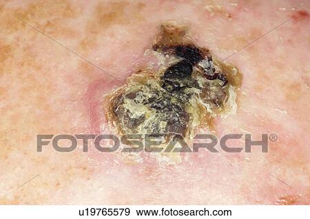 Stock Photo - Skin cancer. Fotosearch