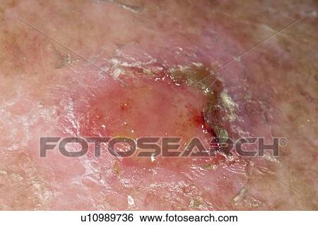 Stock Photograph - Skin cancer. Fotosearch