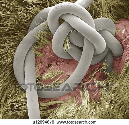 Sutured wound, SEM View Large Photo Image Stock Photo - Sutured wound, SEM. Fotosearch