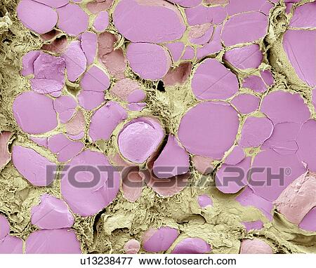 Stock Photo - Thyroid gland, SEM. Fotosearch
