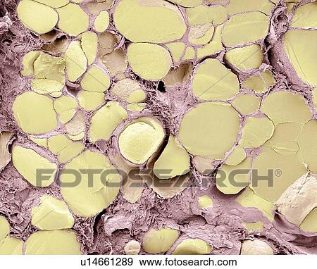 Thyroid gland, SEM View Large Photo Image Stock Photo - Thyroid gland, SEM. Fotosearch