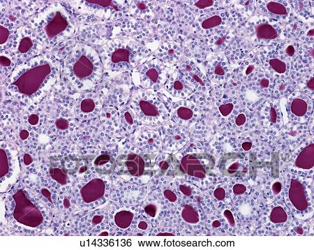 Stock Photograph - Thyroid, light micrograph. Fotosearch