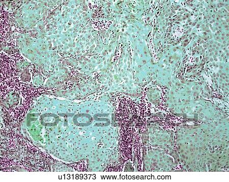 Stock Image - Tongue cancer, light micrograph. Fotosearch