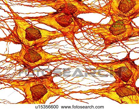 Stock Image - Tumour cells. Fotosearch