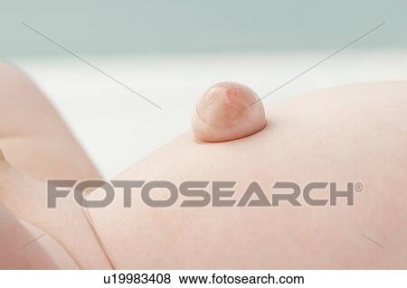 Stock Photo - Umbilical hernia. Fotosearch