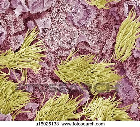 Uterine cancer, SEM View Large Photo Image Stock Image - Uterine cancer, SEM. Fotosearch