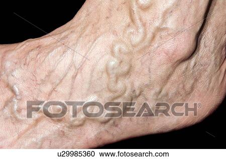 Stock Image - Varicose vein. Fotosearch